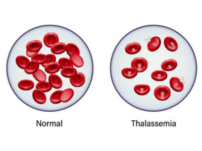beta thalassemia